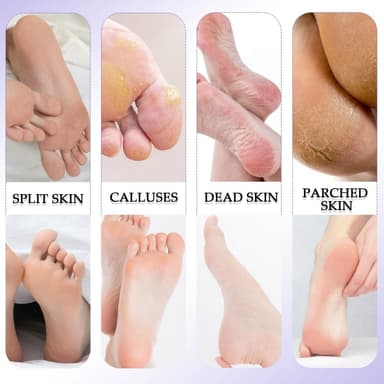 10 stk/sett Fotpleie Pedikyr Callus Dead Skin Remover Fotfil Fjerning av hard hud